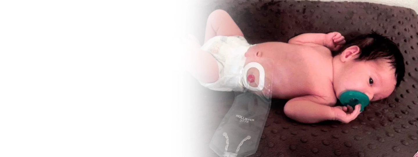 Anorectal Malformation Surgery in Children: Treatment, Cost & Types Explained